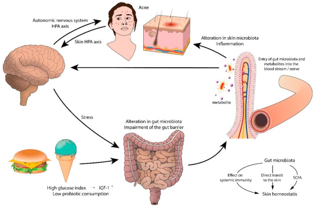 acne figure 1