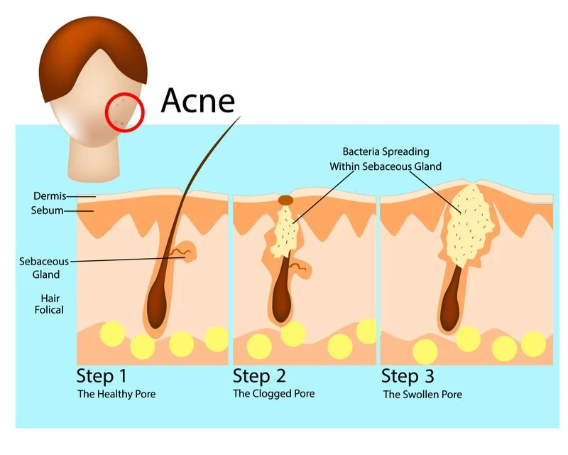 acne figure 2