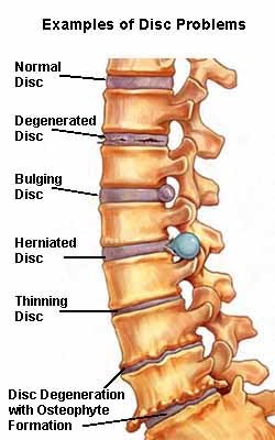 christell life experience Lumbar spondylosis2