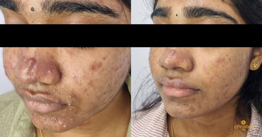 accutane isotretinoin the most honest before and after 01 1