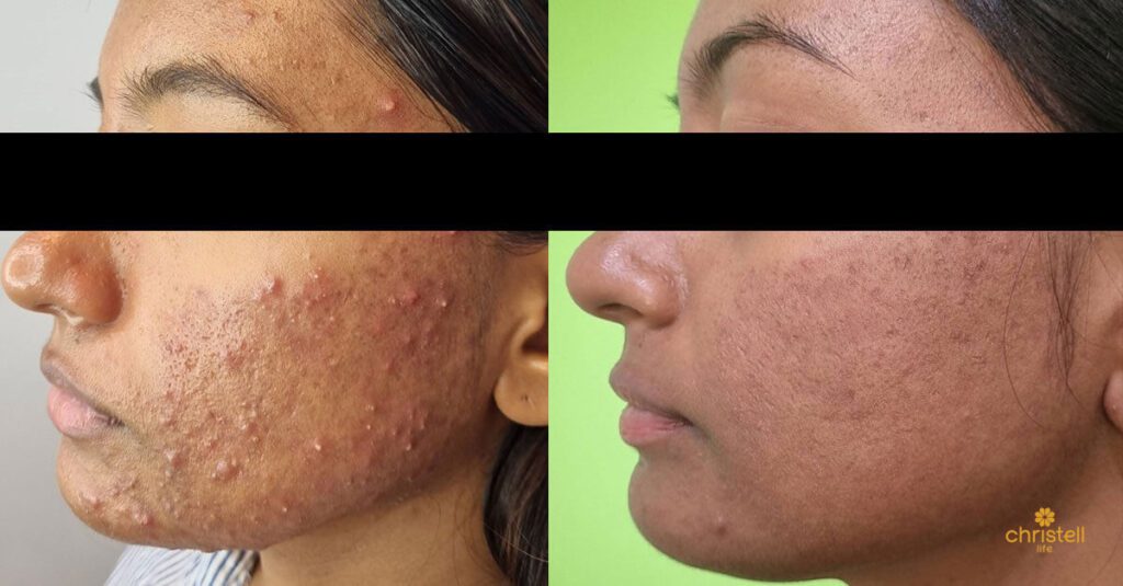 accutane isotretinoin the most honest before and after 04 1