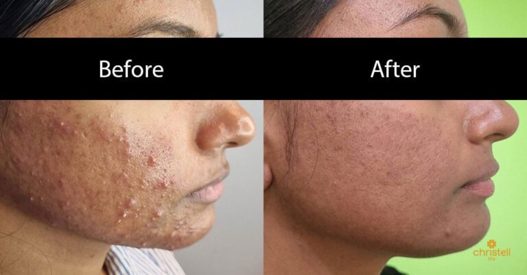 Accutane