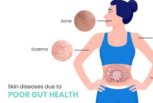 acne and the gut skin connection 1