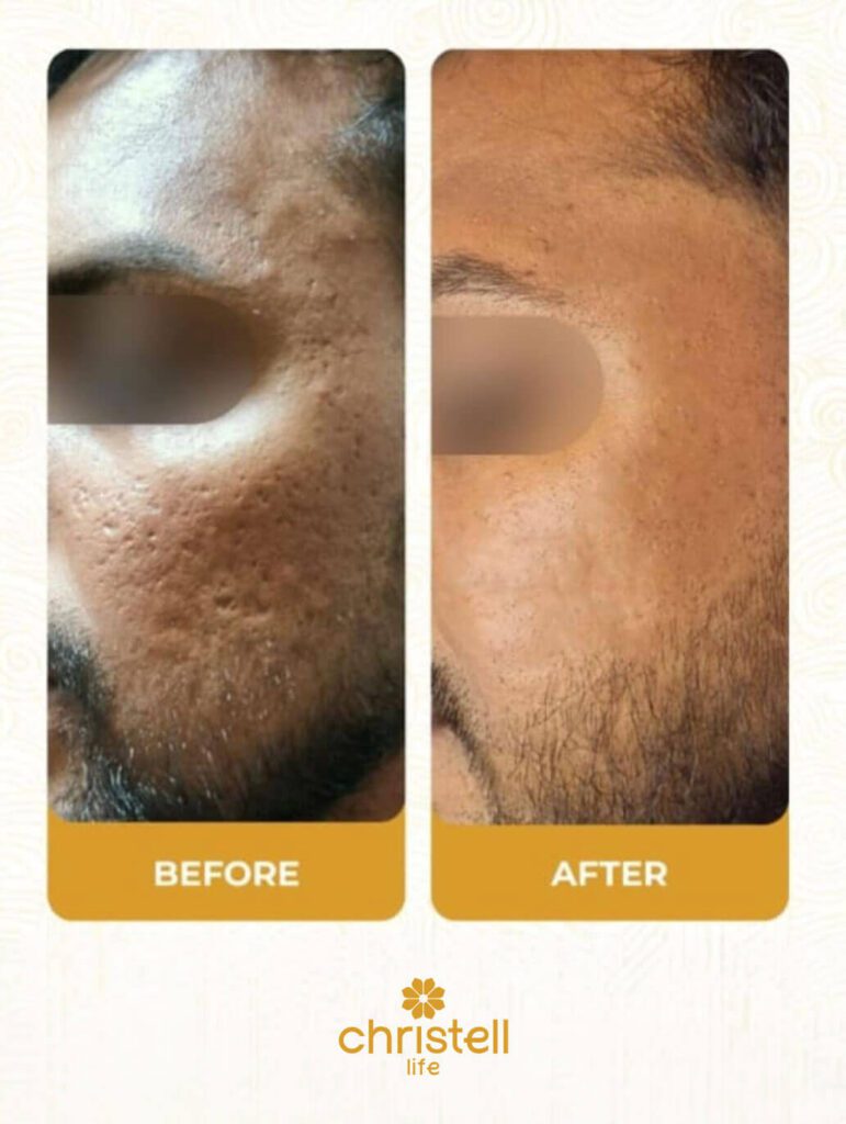 microneedling for acne scars