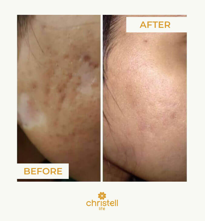 microneedling for acne scars