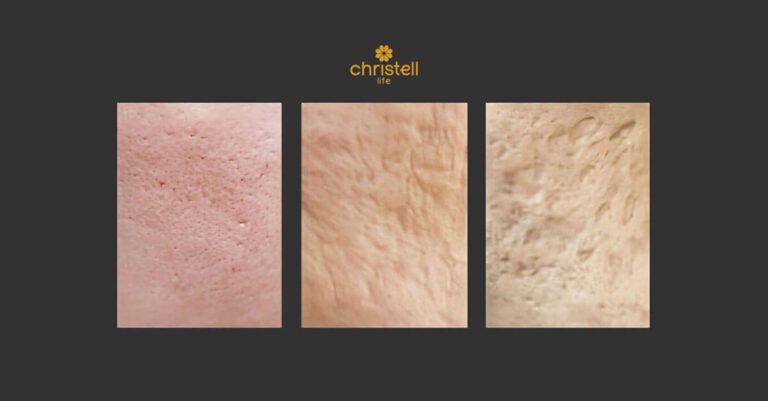 microneedling for acne scars