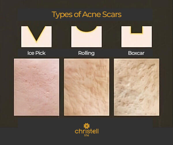 microneedling for acne scars