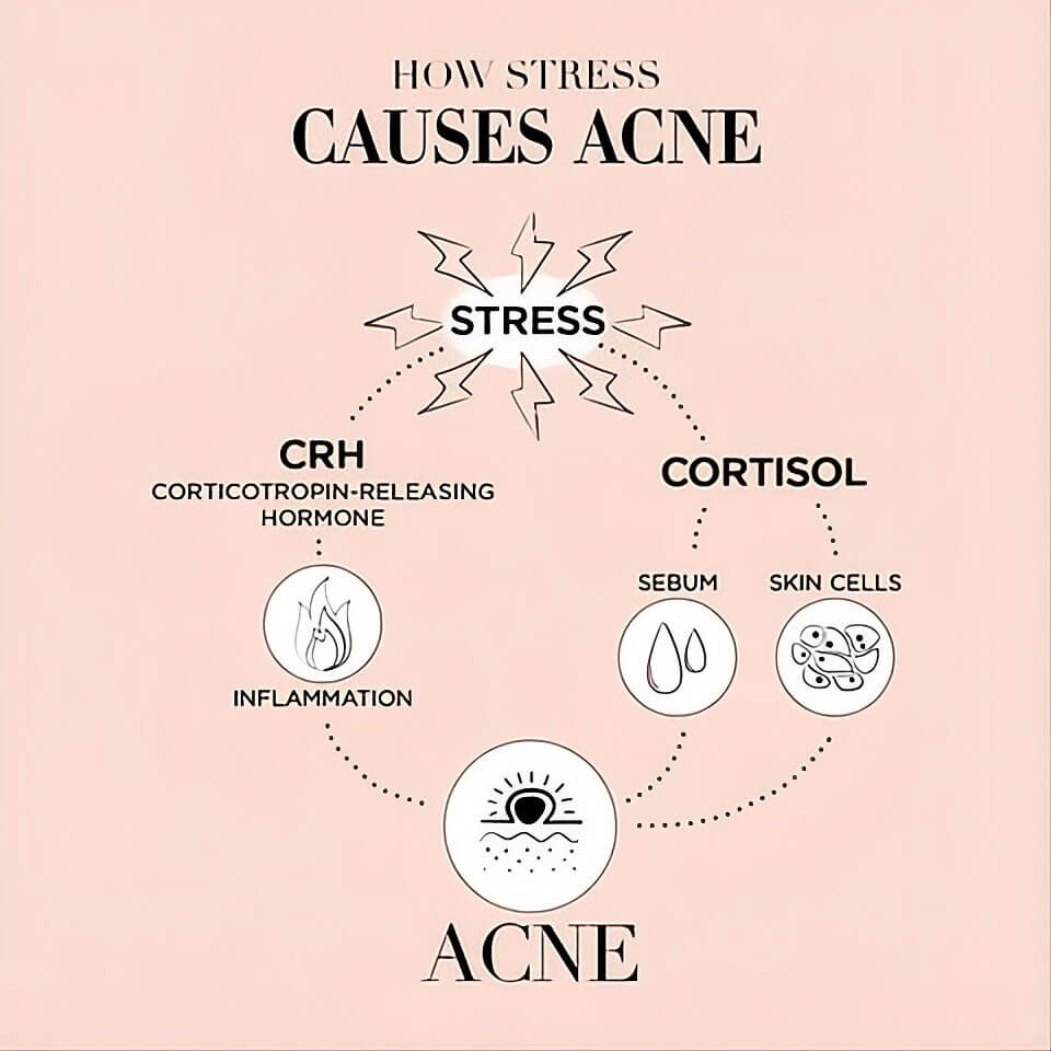 Cortisol Affects Acne