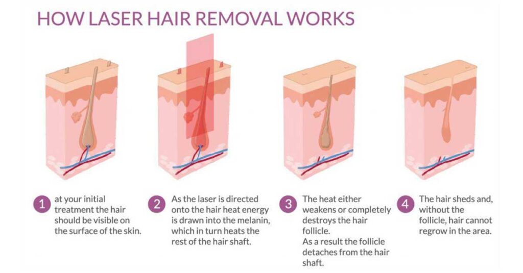 how laser hair removal works christell