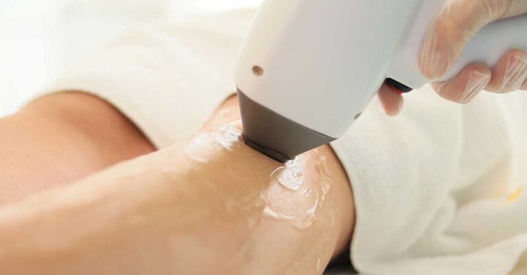 laser hair removal
