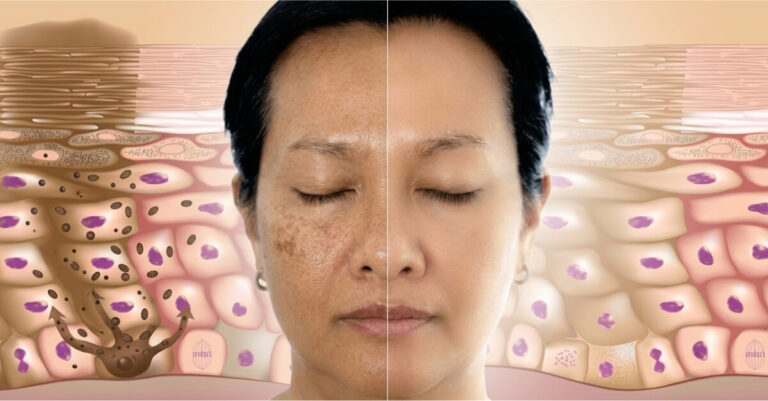 multiple pigmentation treatment sessions needed