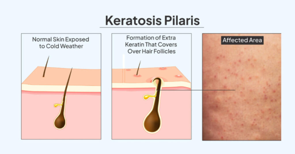 keratosis-pilaris