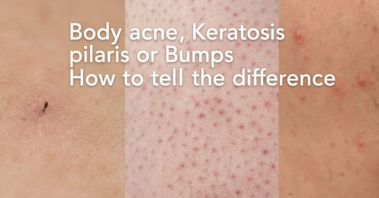treating keratosis pilaris