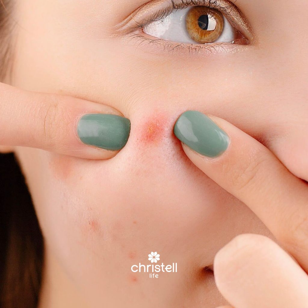 Why Do Pimples Leave Dark Marks? And How Can You Prevent Them?