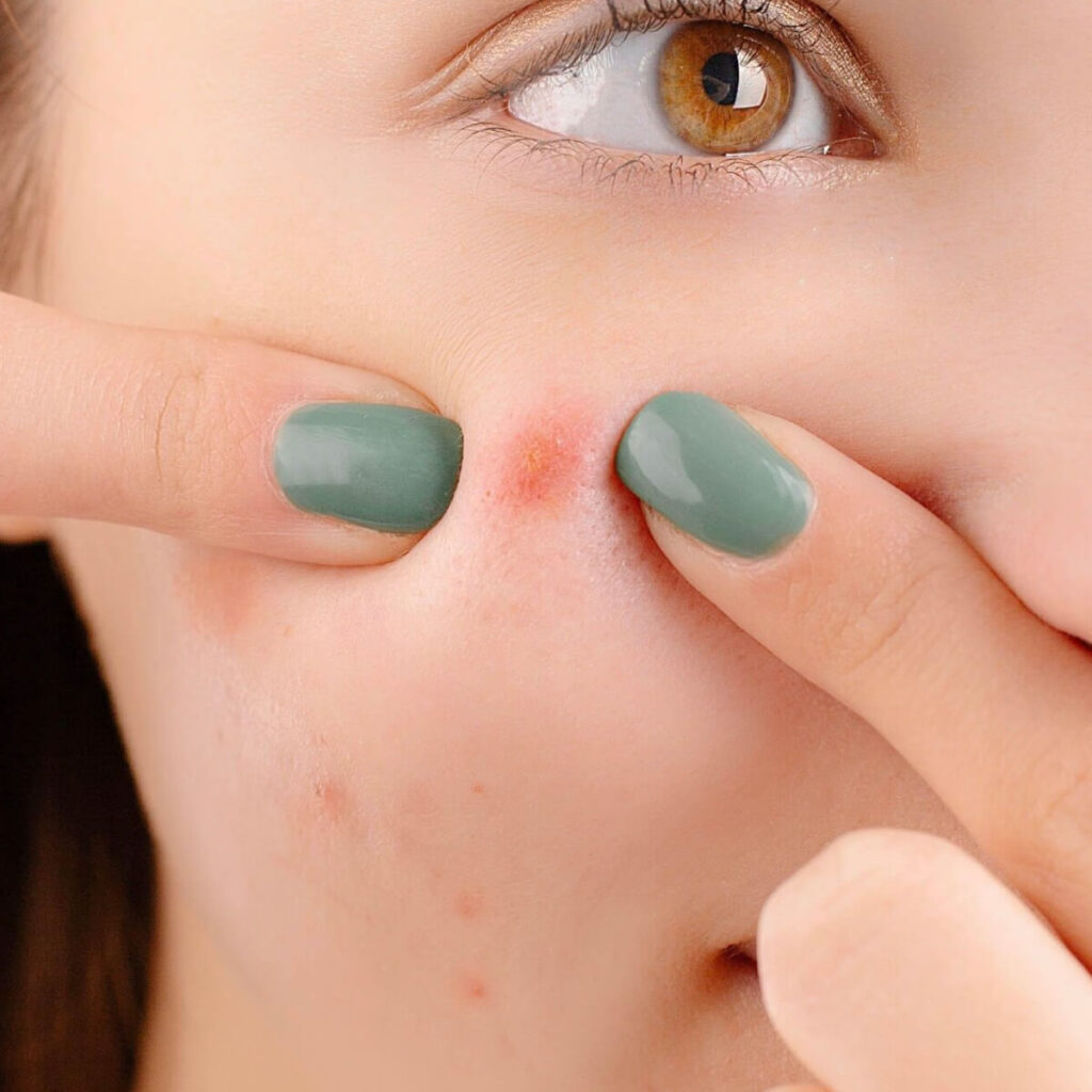 pimples