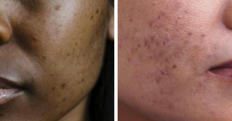 hyperpigmentation